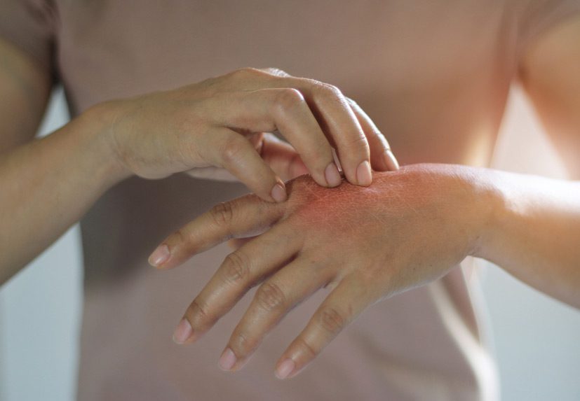 Woman’s-hand-in-pain-from-burn-injury
